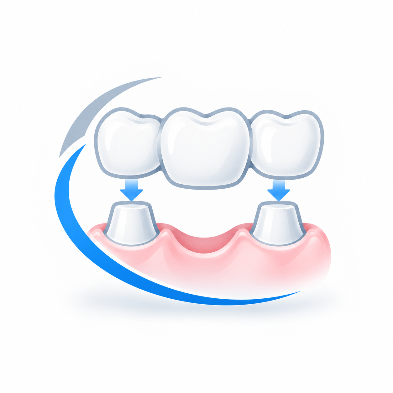 Ilustración de una prótesis dental fija